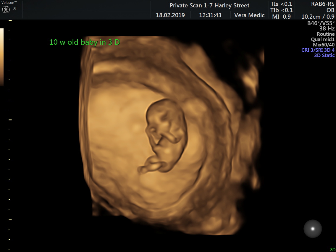 Early Pregnancy Scan by Private Ultrasound Scans London Private Ultrasound Scans London
