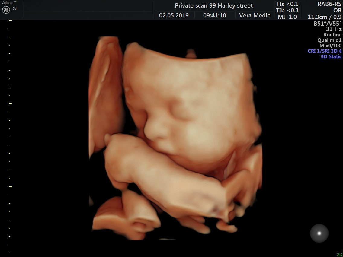 Gender Scan by Private Ultrasound Scans London