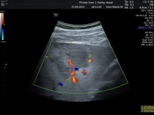 Liver Cancer Scan at Private Ultrasound Scans London