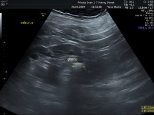 Kidney and Bladder Scan at Private Ultrasound Scans London