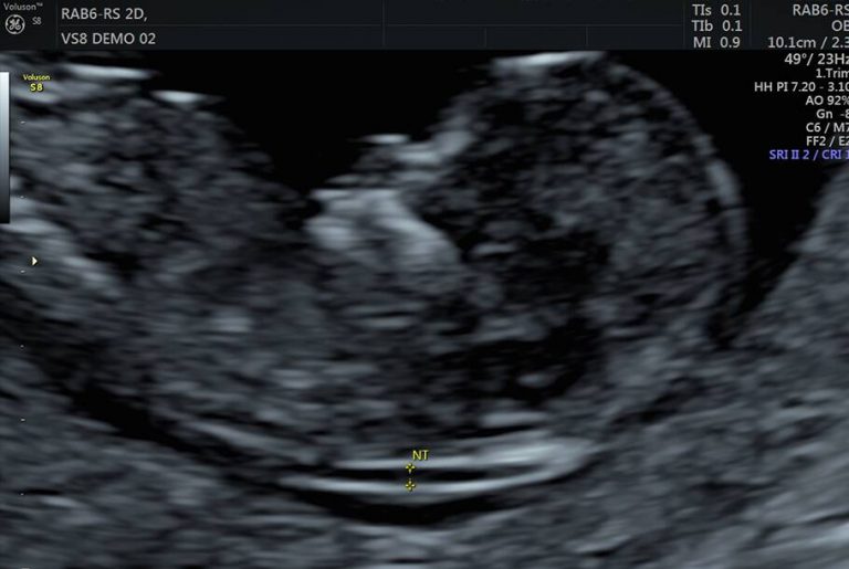 Private Ultrasound Scans London Nuchal Clinic Scan Private Ultrasound Scans London
