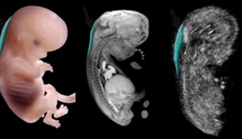 12 WEEK NUCHAL TRANSLUCENCY WITH NIPT HARMONY TEST