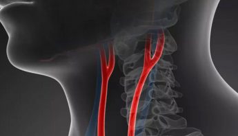 CAROTID SCAN