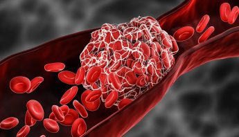 DVT DEEP VEIN THROMBOSIS SCAN