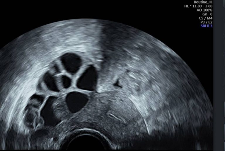 Private Ultrasound Scans London Fertility Scan