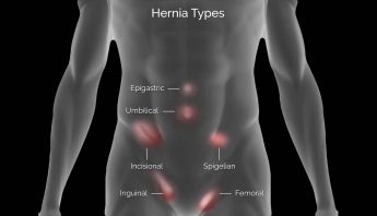 HERNIA SCAN