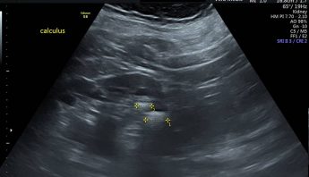 KIDNEY AND BLODDER  SCAN