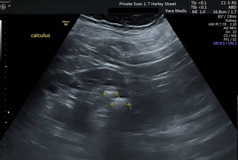 Private Ultrasound Scans London Kidney Scan