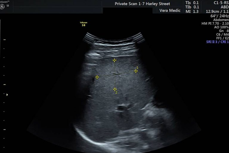 Private Ultrasound Scans London Liver Scan