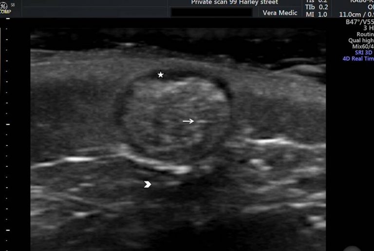 Private Ultrasound Scans London Lumps and Bumps Scan