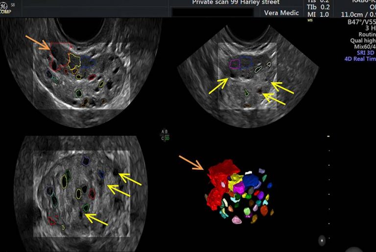 Private Ultrasound Scans London Ovarian Egg Assessment Scan