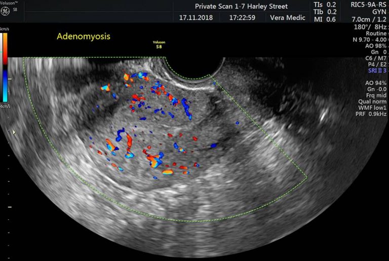 Private Ultrasound Scans London Pelvic Scan