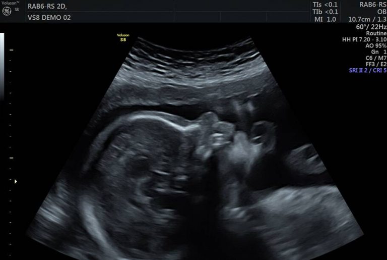 Private Ultrasound Scans London Reassurance Scan