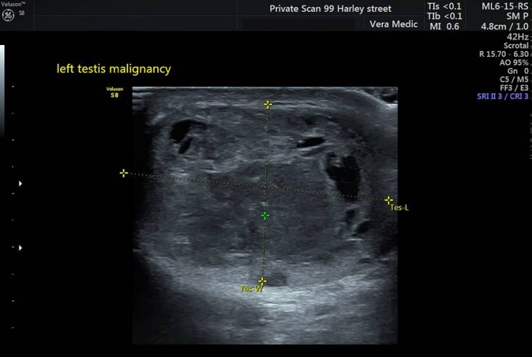 Testicular Cancer Scan