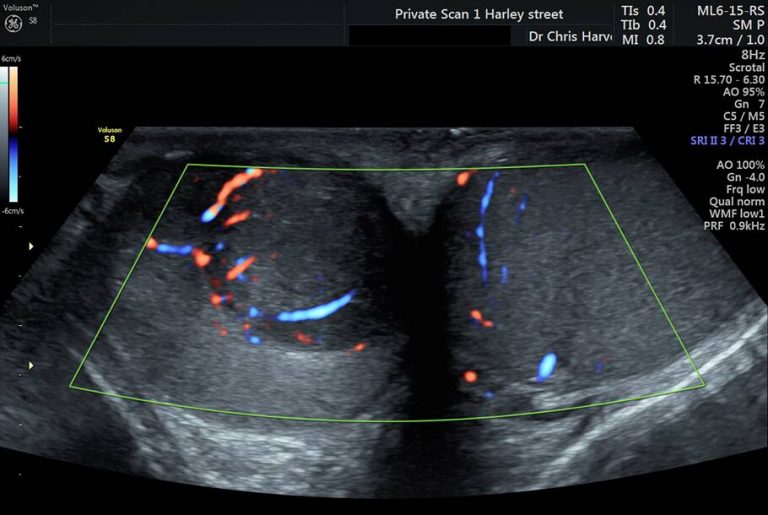 Private Ultrasound Scans London Testicular Scan