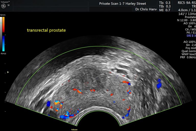 Private Ultrasound Scans London Prostate Scan