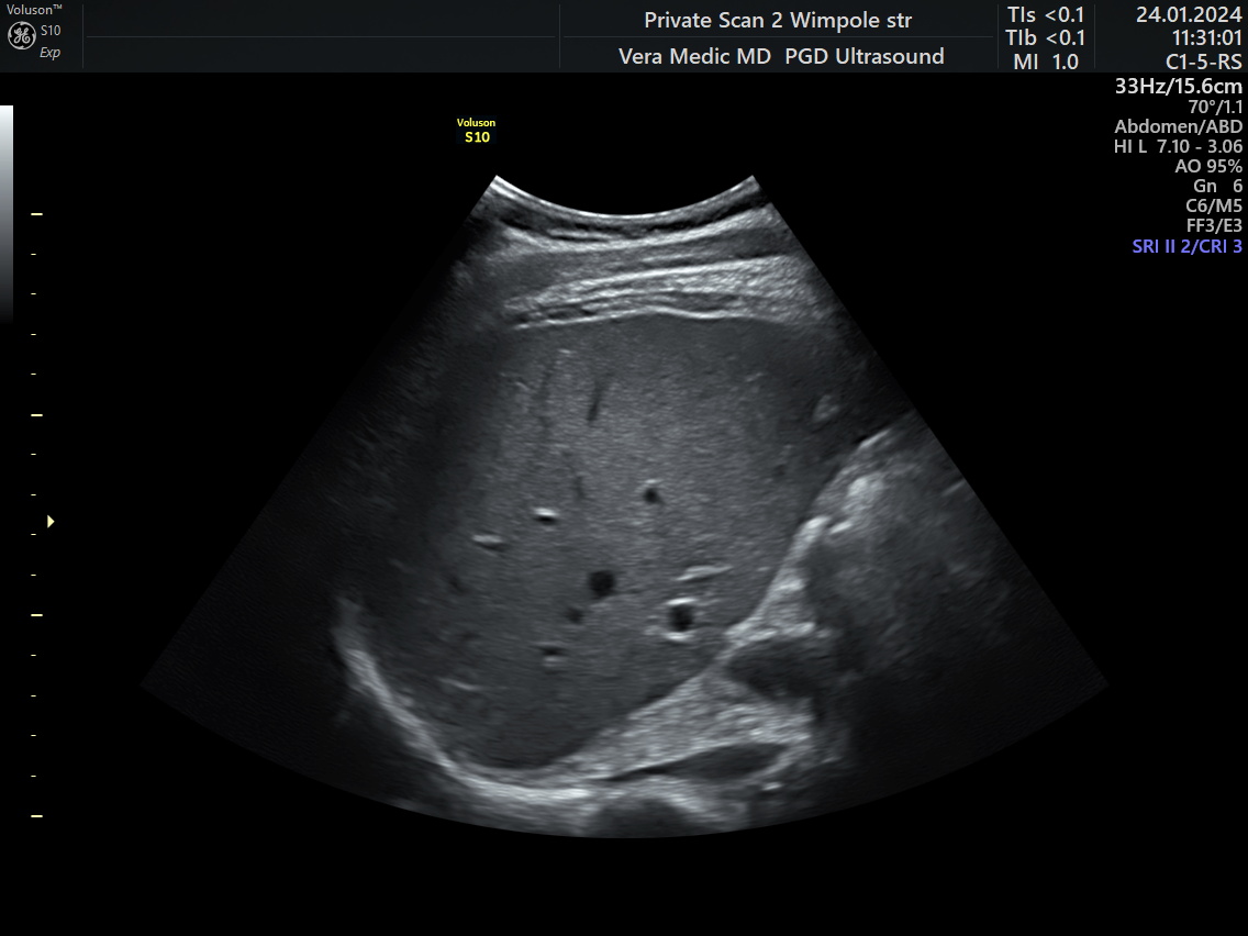 liver scan